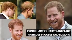 Prince Harry Hair Transplant - Smile ...