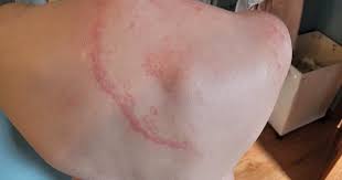 Image result for Eczema nummulare