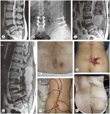 Image result for Spinal Infection