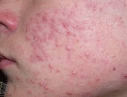 Zona Zoster Sos Dermatolog