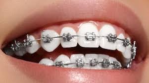 Resultado de imagen para IMAGEN DE BRACKETS METALICOS