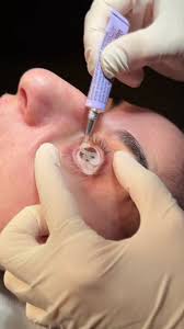 Image result for LET Anesthesia