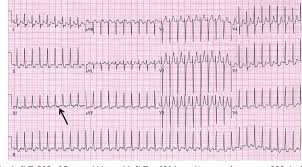 The stress test is an ecg done both at rest and. Figure 1 From Arrhythmogenic Causes Of Chest Pain In Children Semantic Scholar