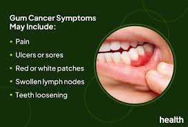 Image result for dental cancer