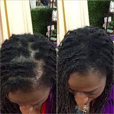 Pin On Make It Fuller Hair Loss Concealer Fibers