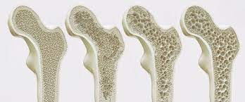 Kemik erimesi belirtileri nelerdir ve tedavisi var mıdır? Turkiye Endokrinoloji Ve Metabolizma Dernegi Osteoporoz Kemik Erimesi Basin Bildirisi Turkiye Endokrinoloji Ve Metabolizma Dernegi