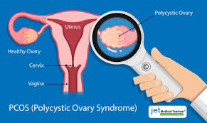 Gastric Sleeve And Pcos Everything You Need To Know