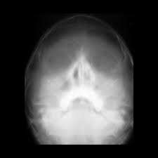 Image result for Sinus X Ray