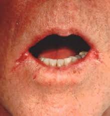 Pain or burning when urinating. Candidiasis Practice Essentials Background Pathophysiology
