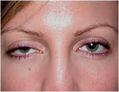 Ptosis Caused By Myasthenia Gravis Damage To Oculomotor Nerve Interference With Sympathetic Nerves Horner S Myasthenia Gravis What Is Like Medical Mnemonics