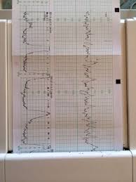Die durchführung der kardiotokographie wird bei risikoschwangerschaften ab der 25. Hohe Des Auschlags Des Ctg Bei Echten Wehen Januar 2014 Babyclub Seite 3 Babycenter