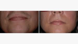 We researched the best options on the market to help you choose. Laser Hair Removal On The Face Cost Procedure And More