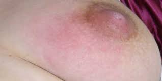 Was Tun Bei Milchstau Stillkinder De