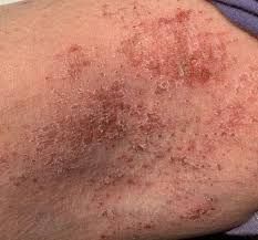Image result for dermatitis contacta allergica