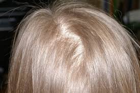 Ainsi, une femme de 60 ans possède la on estime qu'une perte de plus 100 cheveux par jour sur une longue période (plusieurs mois), est une la calvitie ou alopécie androgénétique est une raréfaction de la chevelure. Dermato Info L Alopecie