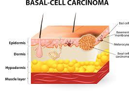 13.09.2021 · skin cancer is common. Types Of Skin Cancer Different Types Treatments Columbia Skin