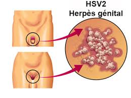 L'Herpès génital traitement naturel