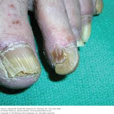 Image result for Onychogryphosis feet