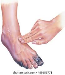 Image result for toe black diabetes