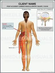This is a diagram of the larger and more surface muscles of the low back. Diagnosis And Treatment Of Lumbar Radiculopathy Premier Law Group