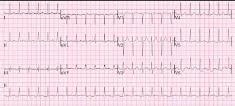 Symptoms may include dizziness, shortness of breath, anxiety, and palpitations. Dr Smith S Ecg Blog An Apparent Svt That Does Not Persistently Correct With Adenosine