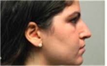 Rhinoplasty Before and After Photos by Mariam Awada, MD, FACS; Southfield,  MI