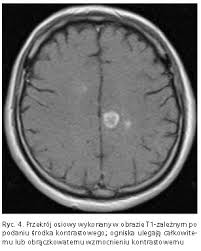 Skuteczności terapii i progresji choroby. Stwardnienie Rozsiane Strona 2 Diagnostyka Psychiatria Medycyna Praktyczna Dla Lekarzy