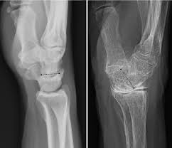 Image result for Wrist XRay