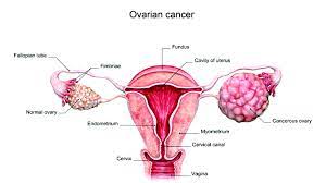 Ovarian cancer has a lifetime risk of around 2% for women in england and wales. What To Know About Ovarian Cancer The Guardian Nigeria News Nigeria And World News Features The Guardian Nigeria News Nigeria And World News