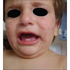 Pritesh Sheth, Author at Indian Journal of Dermatology, Venereology and  Leprology