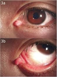Image result for lesion sclera