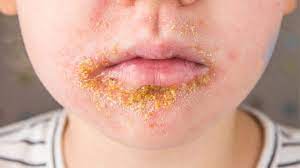 Borkenflechte Impetigo Contagiosa Gesund Bund De