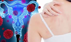 Around 13,980 people are likely to die from this condition. Ovarian Cancer Symptoms Signs Of A Tumour Include A Patchy Rash On Your Skin Express Co Uk