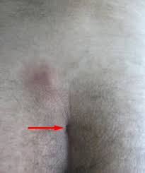 Image result for Pilonidal Cyst