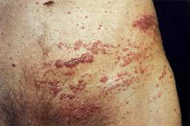 Among a large number of manifestations of hiv infection lesions occupy a special place. Human Immunodeficiency Virus Amboss