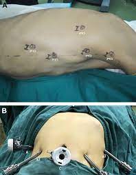 Mckeown esophagectomy is the preferred approach for locally advanced esophageal carcinomas in many centers. The Learning Curve For Robotic Mckeown Esophagectomy In Patients With Esophageal Cancer The Annals Of Thoracic Surgery