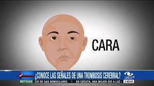 Review of the scientific literature. Aprenda A Reconocer Las Senales De Una Trombosis Cerebral Youtube