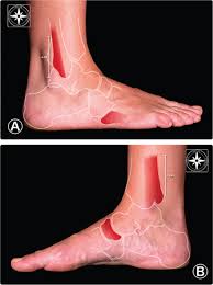 It is comprised of three distinct bands: Aspetar Sports Medicine Journal Ankle Sprain Diagnosis And Therapy Starts With Knowledge Of Anatomy