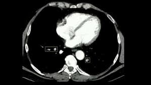 Hace unos meses me dio un trombopulmonar y me estado tratando despues con anticuagualante. Embolia Pulmonar Diagnostico E Tratamento Fisioterapia Para Todos