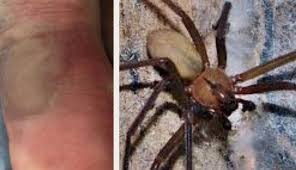 La araña violinista, o del rincón, es conocida por su marca en la cabeza en forma de violín, normalmente mide de 1.8 a 3 centímetros de largo, tiene seis ojos, ocho patas y es de color café o gris. Mujer De 70 Anos Se Encuentra Grave Por Picadura De Arana Violinista