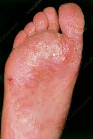 Image result for Candidiasis