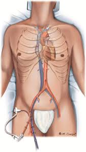 Liver pain is felt in the upper right area of the abdomen, just below the ribs. Structured Review Of Post Cardiotomy Extracorporeal Membrane Oxygenation Part 1 Adult Patients The Journal Of Heart And Lung Transplantation