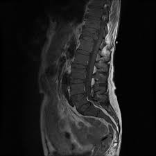 Something, such as the keel of a ship, that resembles a backbone. Diffuse T1 Bone Marrow Signal Loss Radiology Reference Article Radiopaedia Org
