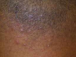 Keep the head of the electric razor slightly off the surface of the skin and shave in a slow, circular. Folliculitis Keloidalis Dermnet Nz