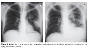 Da wikipédia, a enciclopédia livre. Jornal Brasileiro De Pneumologia Capitulo 7 Zigomicose