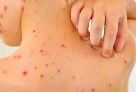 Makin ramai yang dijangkiti demam campak jika tahap suntikan vaksin semakin menurut. 8 Cara Nak Bezakan Demam Campak Dan Cacar Air Free Malaysia Today Fmt