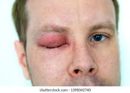 Man Swollen Eye Bee Sting Stock Photo 1398342740