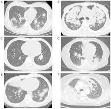 Just a video of my story and what made me go see a doctor. Diagnostic And Prognostic Factors For Patients With Primary Pulmonary Non Hodgkin S Lymphoma A 16 Year Single Center Retrospective Study