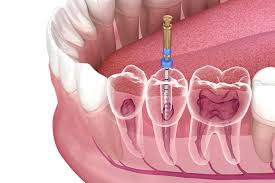 How long does a root canal take if you don't care if it lasts? Root Canals Family Dentistry Dental Health Associates Madison