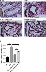 Correction to: Inhibition of microRNA-451 is associated with increased  expression of Macrophage Migration Inhibitory Factor and mitigation of the  cardio-pulmonary phenotype in a murine model of Bronchopulmonary Dysplasia 